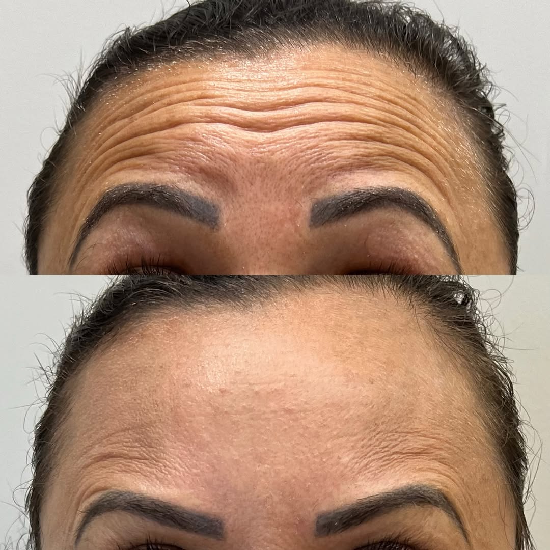 Resultado Toxina Botulínica - Dra. Thaisla Diniz