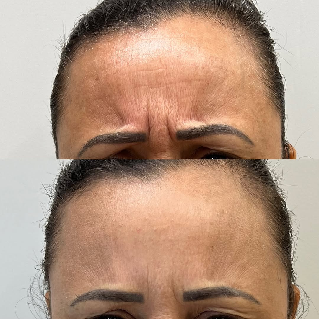 Resultado Toxina Botulínica - Dra. Thaisla Diniz