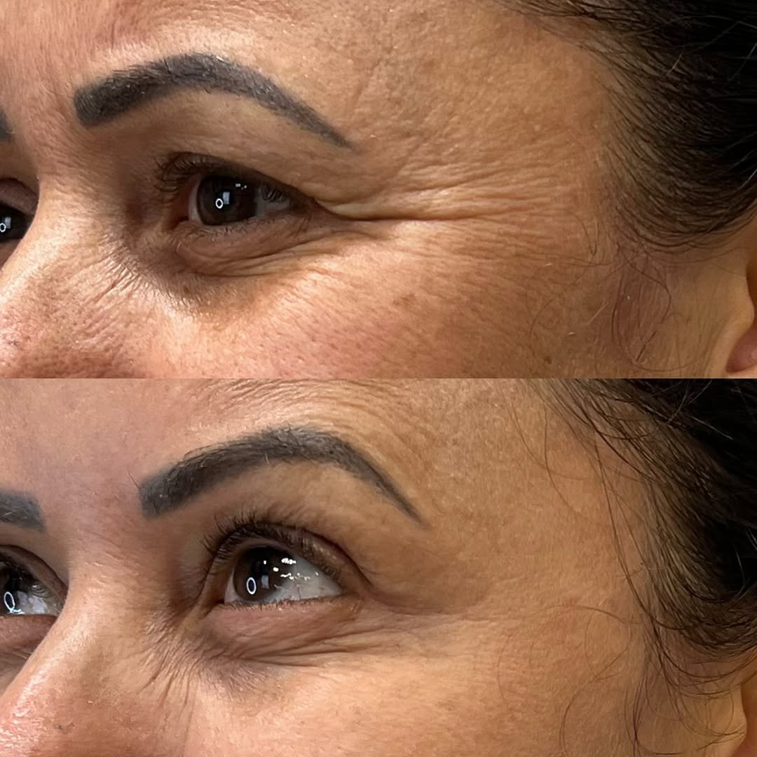 Resultado Toxina Botulínica Full Face - Dra. Thaisla Diniz