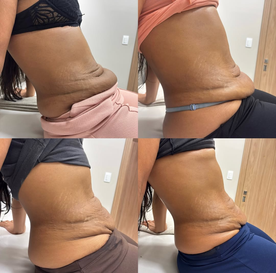 Resultado Protocolo Flacidez - Dra. Thaisla Diniz