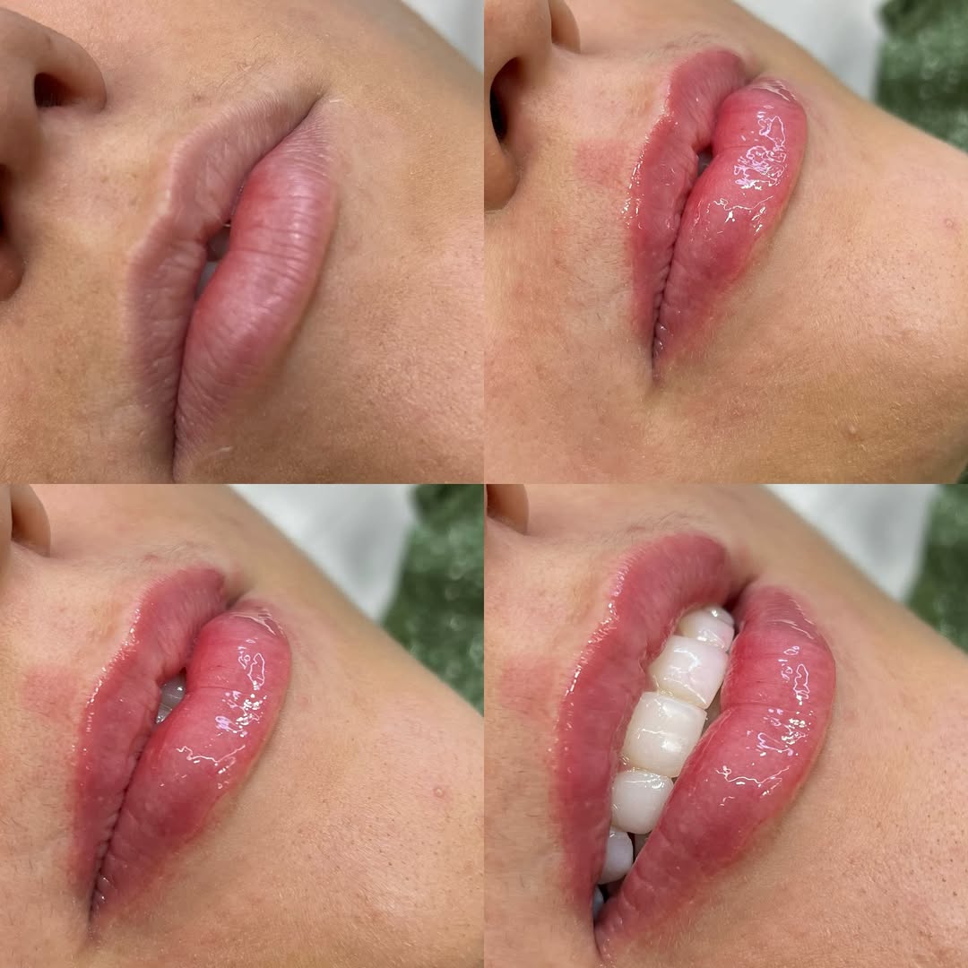 Resultado Hidrogloss - Dra. Thaisla Diniz