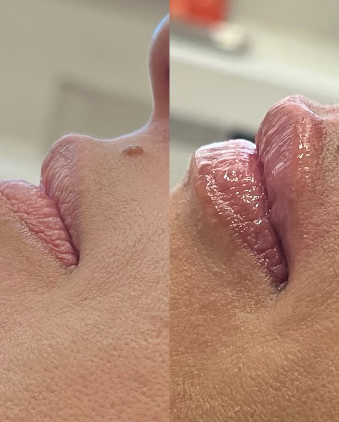 Resultado Preenchimento Labial - Dra. Thaisla Diniz