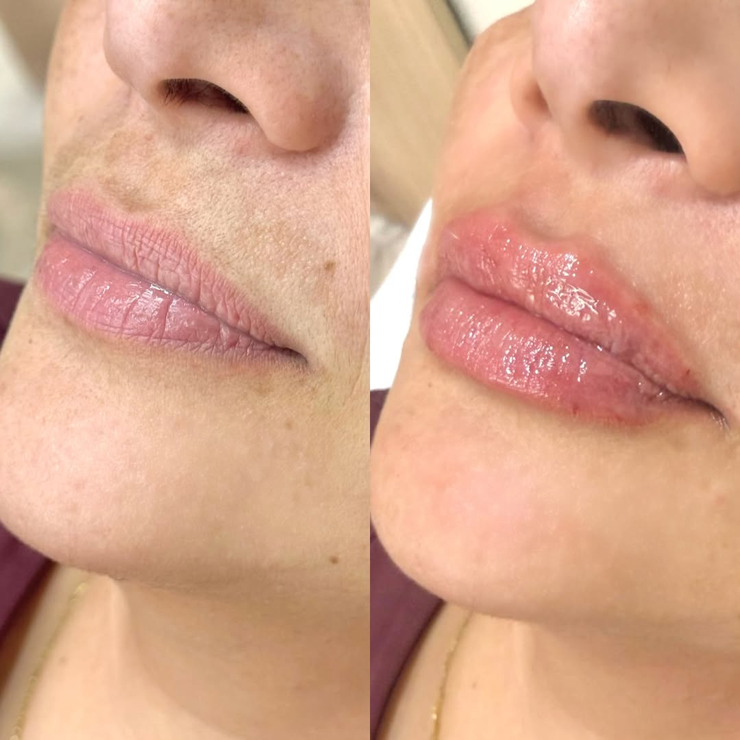 Resultado Preenchimento Labial - Dra. Thaisla Diniz