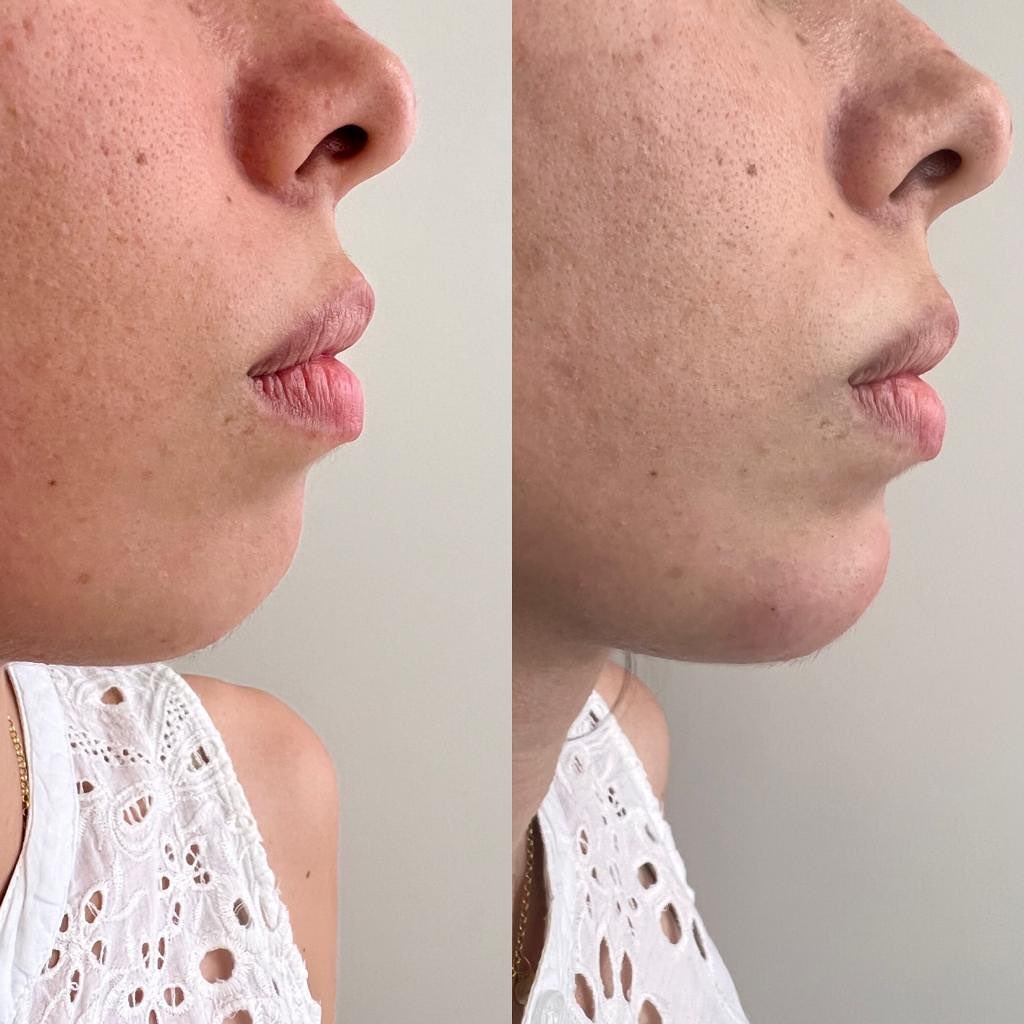 Resultado Preenchimento de Queixo - Dra. Thaisla Diniz